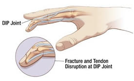 If you think you might have a jammed finger, it's important to get treatment right away. Mallet Finger London Hand Surgeon