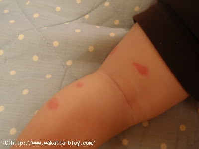 50 赤ちゃん 虫 刺され の よう な 湿疹 画像ブログ