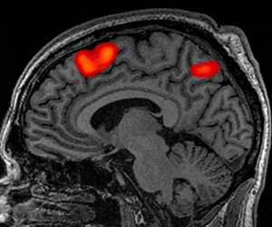 Processing speed important to higher order cognitive function in multiple sclerosis patients