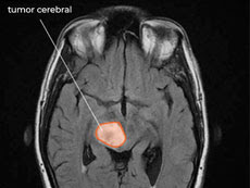 RM de glioma difuso de línea media en el cerebro.