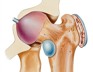 What is Trochanteric Bursitis?