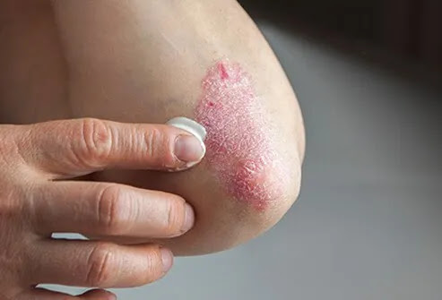 Psoriasis plaques tend to form on the elbows, knees, and scalp.