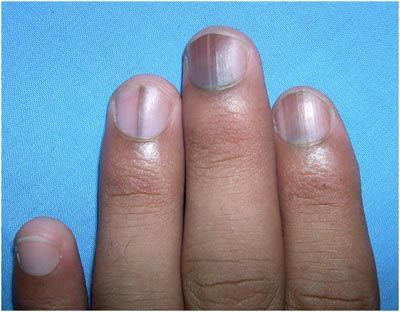 Vertical Lines In Nails Vitamin Deficiency Awesome Nail