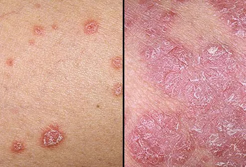 Photo of psoriasis symptoms.