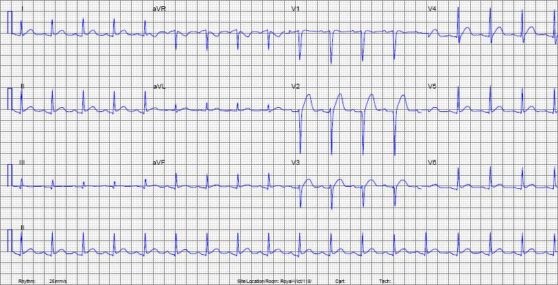 Paroxysmal supraventricular tachycardia (psvt) is a heart condition involving an abnormal conduction of electricity in particular areas of the paroxysmal supraventricular tachycardia (psvt). Mcgill Ekg Learning Project