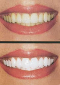 Cara-cara nak bagi gigi yang kuning menjadi putih semula 