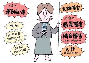 最高の無料イラスト 75 脳 梗塞 イラスト