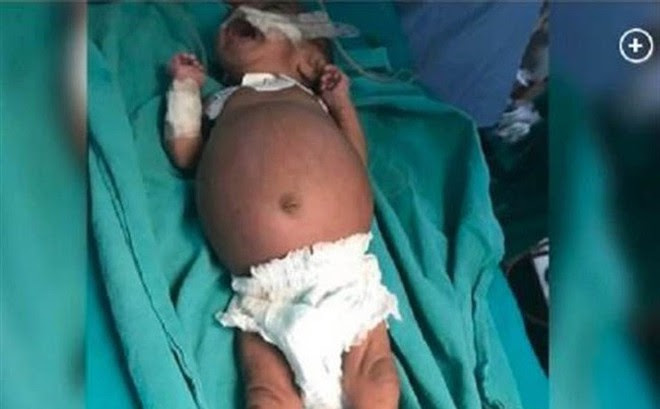 Bé gái sinh ra với chiếc bụng sưng to bất thường, vài ngày sau vẫn không thuyên giảm, nhập viện thì bác sĩ mổ ra đứa trẻ thứ 2