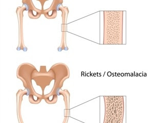 Rickets traced back to Roman Empire