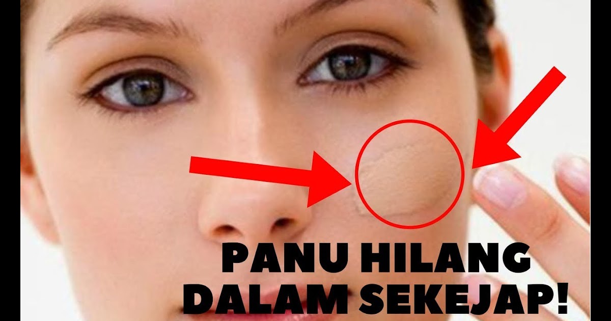 cara hilangkan panau di muka