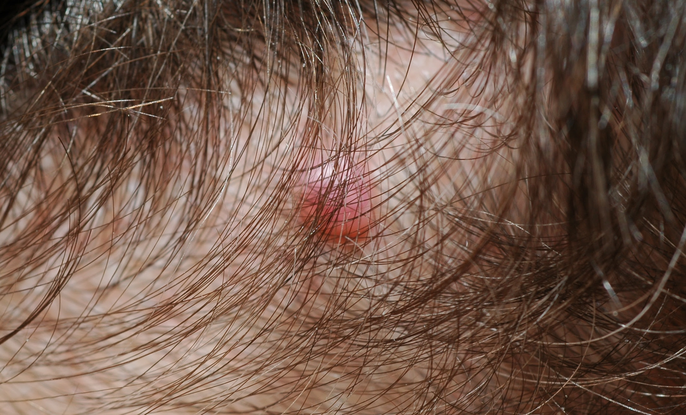Examine your chest and trunk, and. Families Prone To Melanoma A Newly Recognised Familial Melanoma Gene Bap1
