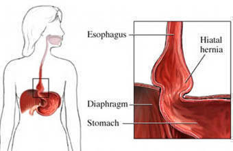 The rib cage protects vital internal organs. Hiatal Hernia Www Headbacktohealth Com