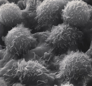 Hairy cell leukemia cell (Dept. of Energy)