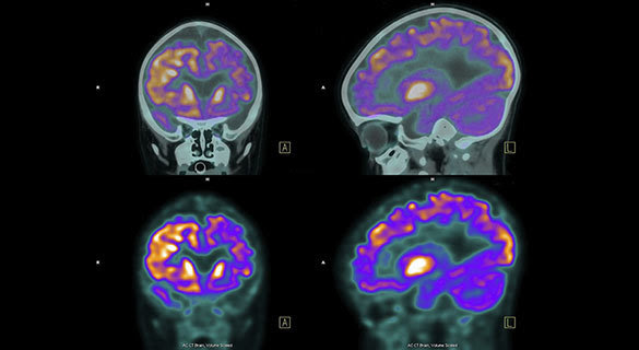 iStock photo of human brain PET scan images