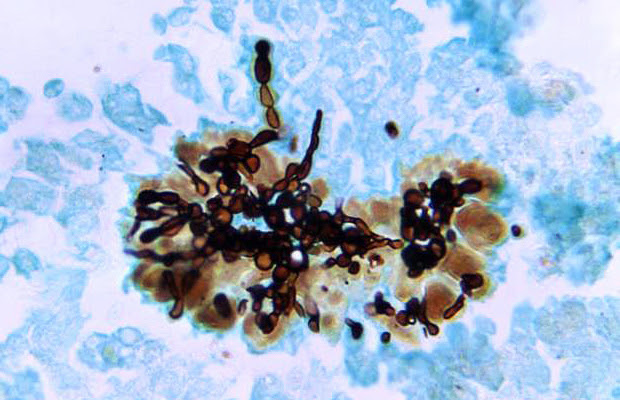 A photomicrograph of liver tissue specimen with dark chains of fungi.