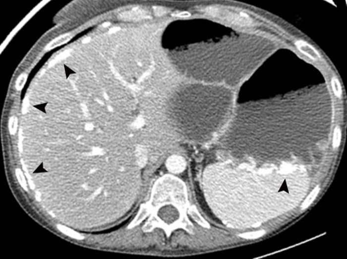 Peritoneal Mesothelioma Liver Metastases