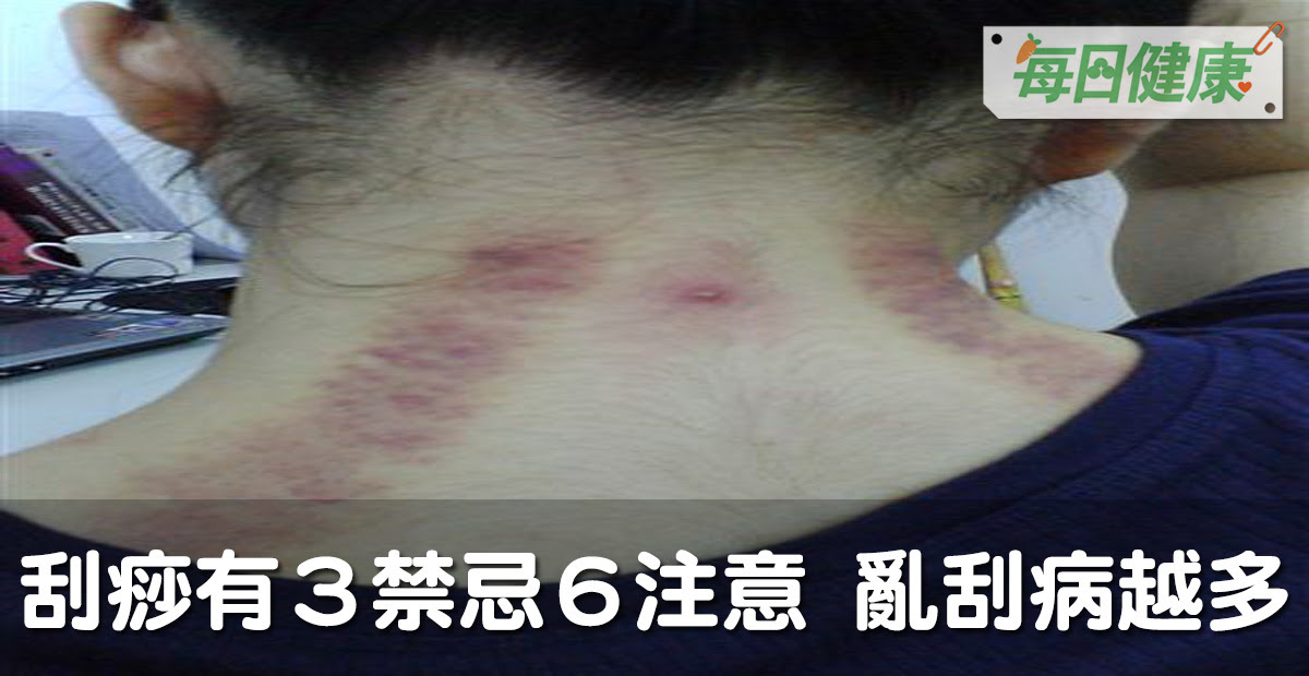 电脑游戏设计师许大同（梁家辉 饰）与妻子简宁（蒋雯丽 饰）在美国奋斗了8年，事业有成。 一次意外却令美好的家庭变得愁云惨雾：5岁的儿子生病了，老父亲（朱旭 饰）用传统的中国民间刮痧. åˆ®ç—§æœ‰ä¸‰ç¦å¿Œå…­æ³¨æ„ äº‚åˆ®å°å¿ƒé¢¨é‚ªå…¥ä¾µ è¶Šåˆ®ç—…è¶Šå¤š æ¯æ—¥å¥åº·health æ¯æ—¥å¥åº·health