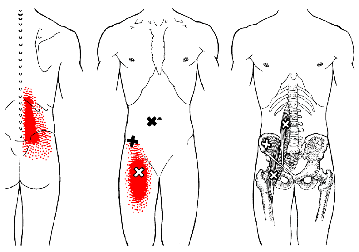 Iliopsoas