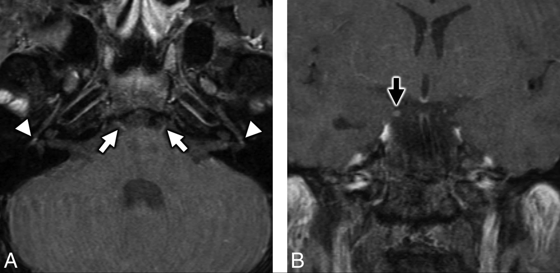 Sindrome de guillain‐barré associada ao covid‐19. Covid 19 Associated Bifacial Weakness With Paresthesia Subtype Of Guillain Barre Syndrome American Journal Of Neuroradiology