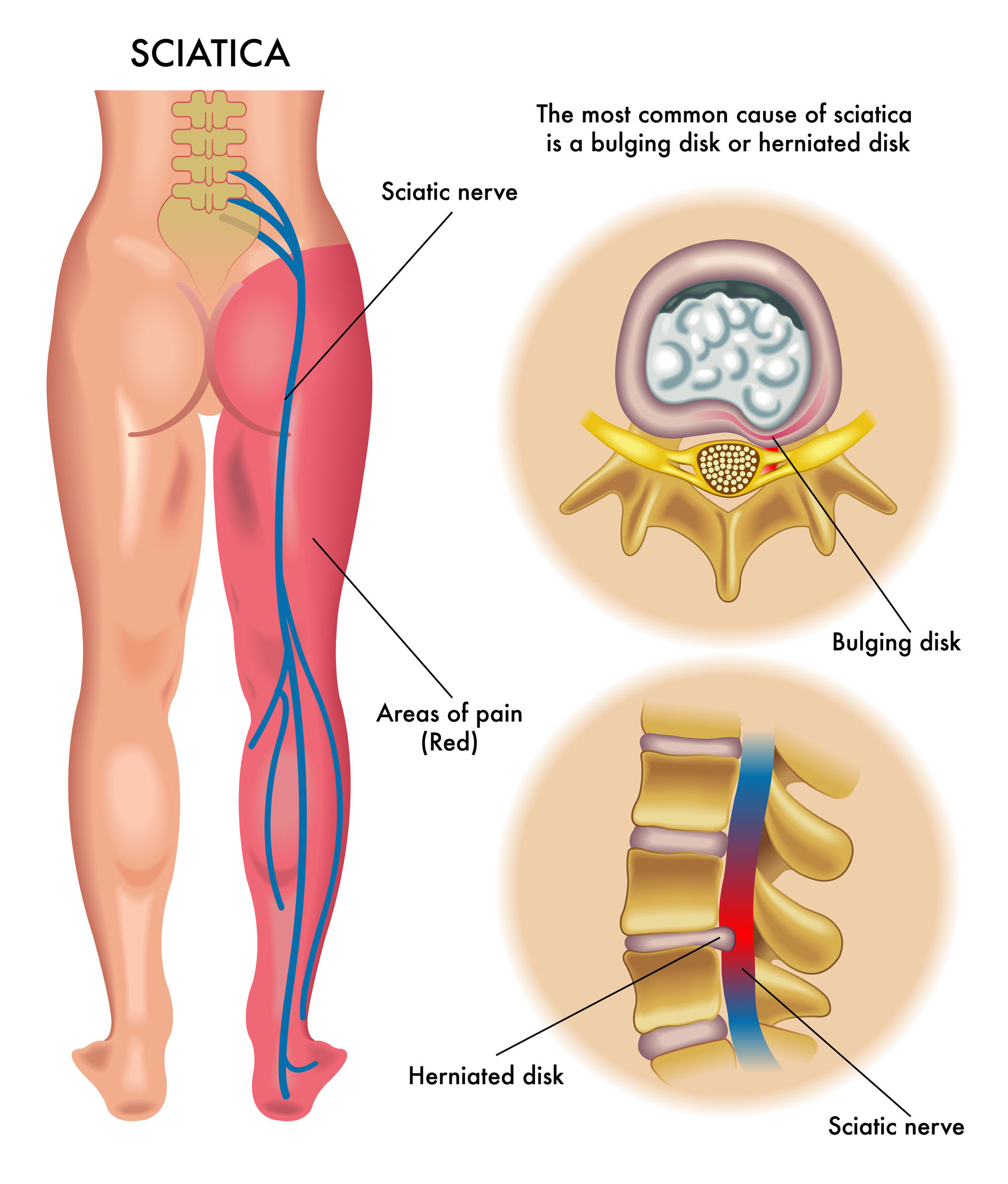 Tighten your pelvic floor muscles, hold the contraction for five seconds, and then relax. Back Pains Midback Pains Neck Pains Max Superspecialty Ortho Clinic