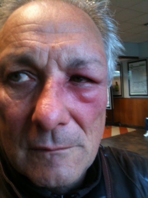 70 Ou Plus Piqure Oeil Bebe 3296 Piqure Moustique Oeil Bebe Imagesgratuitesasj