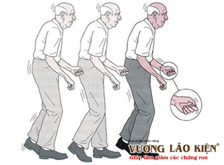 Bệnh Parkinson và 10 dấu hiệu cảnh báo