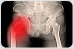 Hip fractures may serve as first sign of undiagnosed Alzheimer’s disease