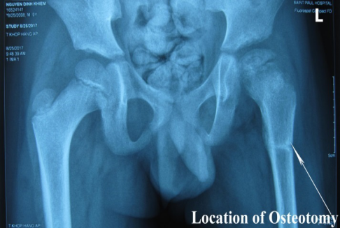 Doctors say a full recovery could take 18 months. The Incomplete Proximal Femoral Osteotomy For Legg Calve Perthes Disease In Children Hung International Journal Of Orthopaedics