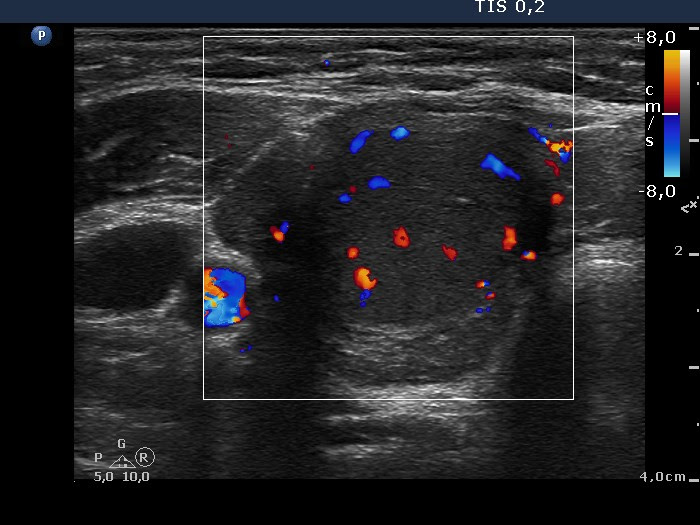 The differential diagnosis for grave's disease on ultrasound is hashimoto's thyroiditis. Graves Disease