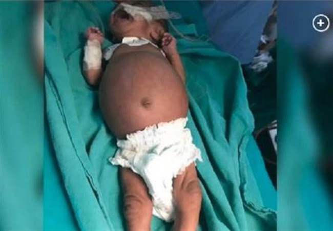 Bé gái sinh ra với chiếc bụng sưng to bất thường, vài ngày sau vẫn không thuyên giảm, nhập viện thì bác sĩ mổ ra đứa trẻ thứ 2 - Ảnh 1.