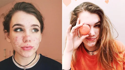Teen Says Acne Medication Doxycycline Led to Her Vision Loss | Allure
