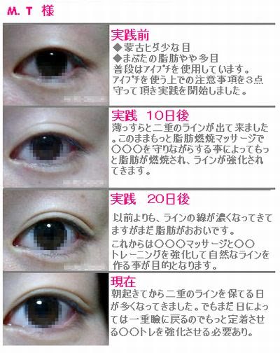 コレクション 瞼の脂肪 落とす 運動 瞼の脂肪 落とす 運動