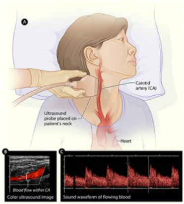 How Many Carotid Arteries In The Neck - Clearing Clogged ...