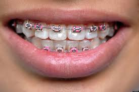 They may make you as attractive as you hoped your newly. Braces As A Fashion Statement Mint Dental