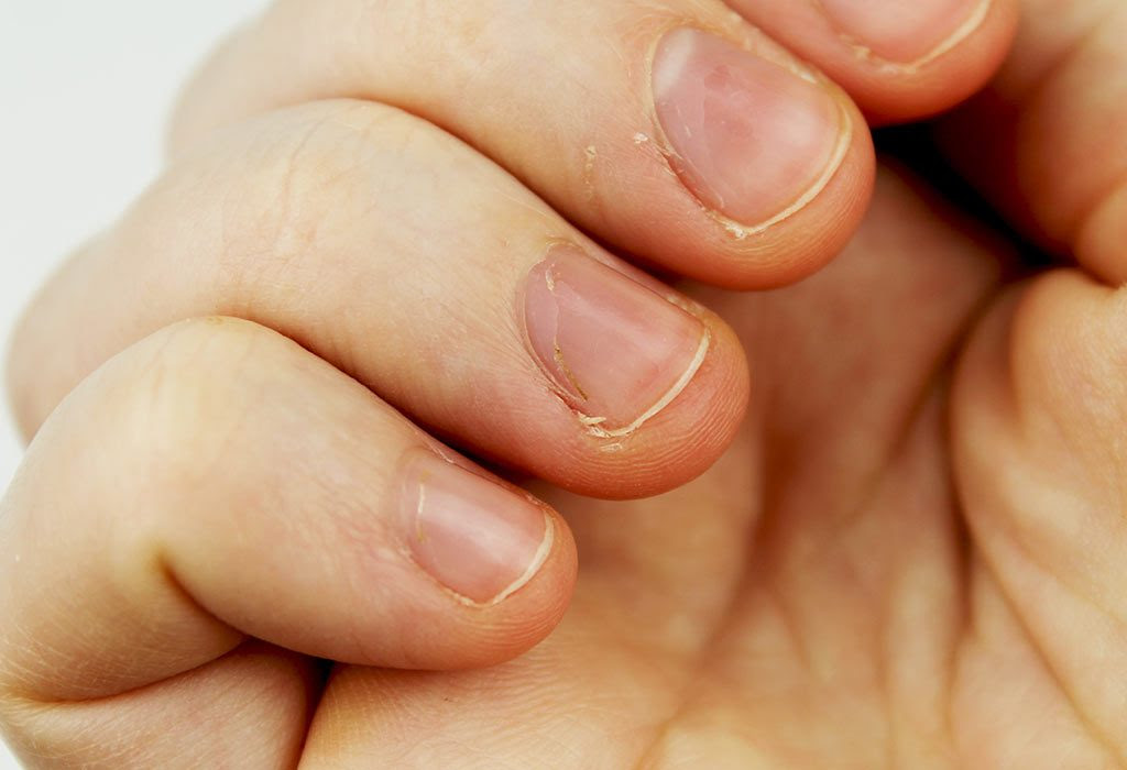 White spot on toe nail near cuticle. White Spots Or Leukonychia On Child S Nails Symptoms Home Remedies