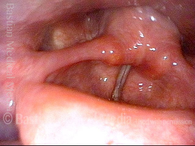 Gerd Mucus Treatment - bronchitis contagious