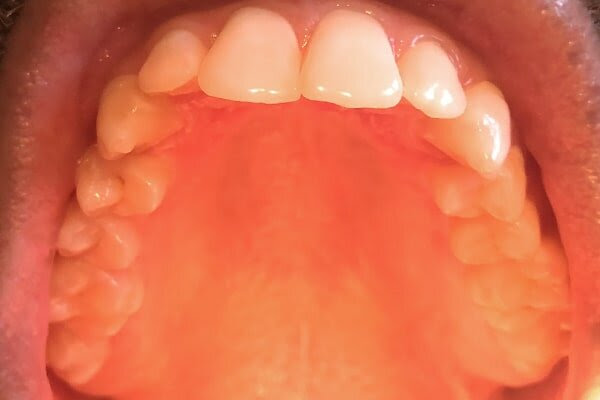 But in rare cases, it might. 8 Reasons Why The Roof Of Your Mouth Is Itchy