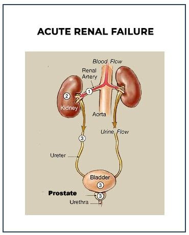 Chronic renal failure is a slow, progressive decline of kidney function. Acute Renal Failure Treatkidney
