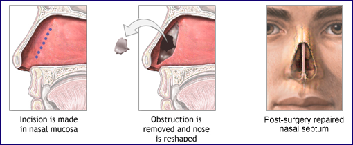 The nasal septum is the wall between the nostrils that separates the two nasal passages. Septoplasty