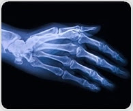 Researchers detect molecular biomarker for osteoarthritis using nanotechnology