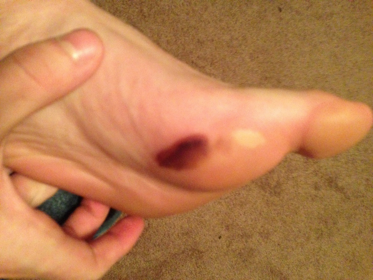 The bruise on the bottom of foot is also known as the heel pain. Bruised Foot Question Please Help Barefoot