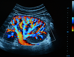 Kidney ultrasound