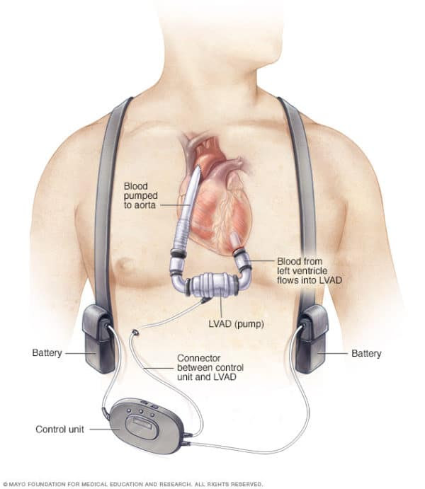 Artificial hearts implanted there must be proportionality between risk for the patient & the benefits.One specific field of use is paediatric heart surgery,