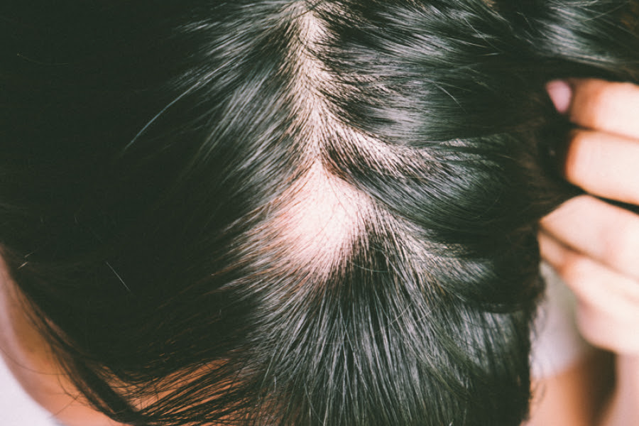 Quelle Coupe Quand On Perd Ses Cheveux Femme : Cancer Comment Choisir Une Perruque L Express Styles