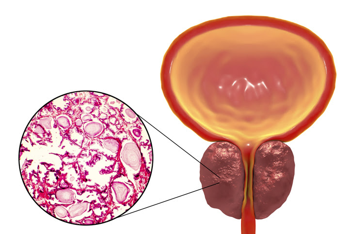 ilustracion de una prostata con cancer