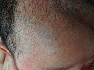 √1000以上 赤ちゃん 頭皮 赤くなる 210615-赤ちゃん 頭皮 赤くなる