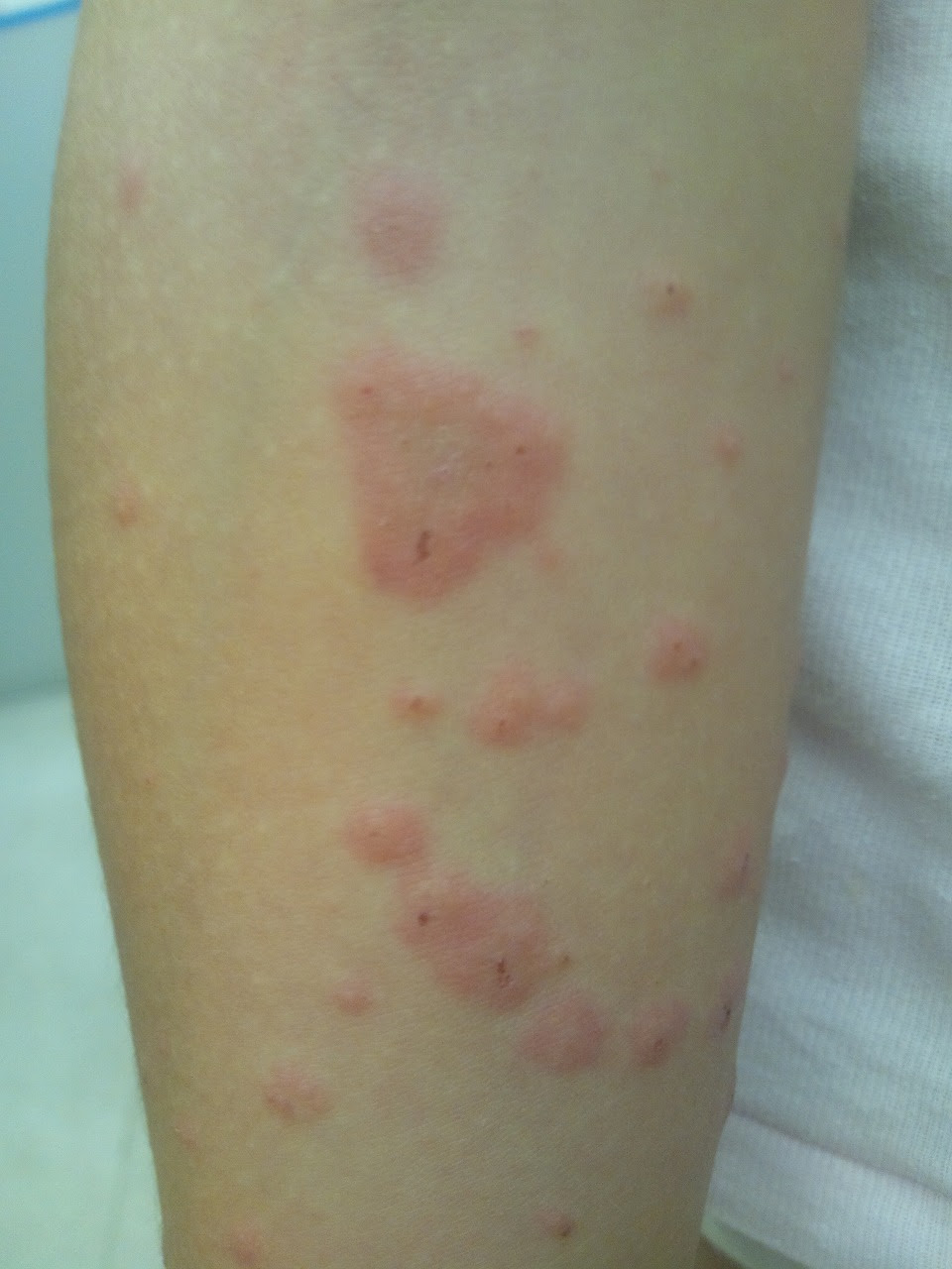 赤い 斑点 かゆく ない お腹 子どもの赤い発疹 熱なし かゆみなし 水いぼや突発性発疹かも 医師監修