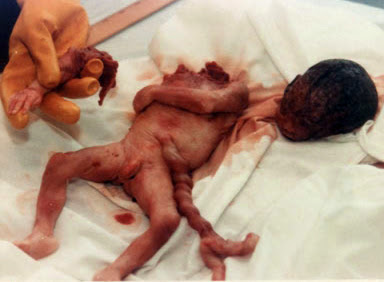 Resultado de imagen de ImÃ¡genes de abortos