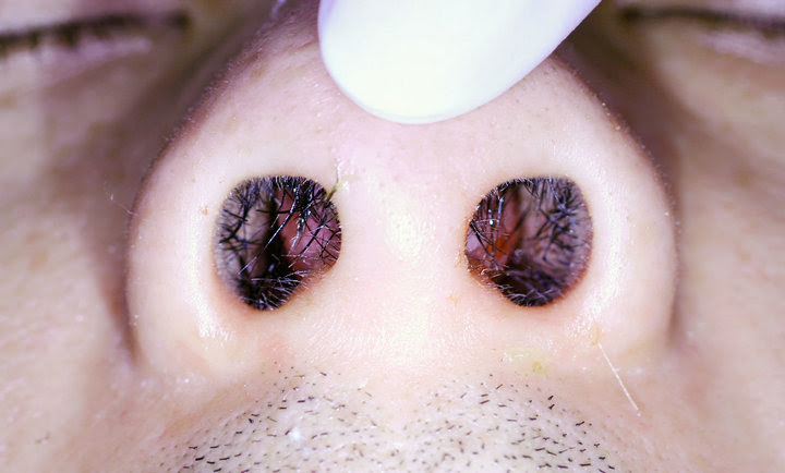 Memahami Disparitas Polip  Sinusitis Alodokter