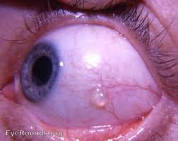There's a Bump on My Eye Part 2: Conjunctival Cyst ...